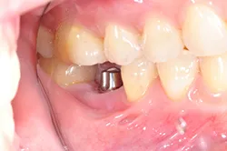 An actual implant inside a healthy mouth.
