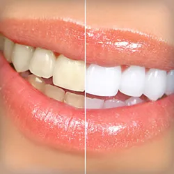 Compare Lasersmile with other Teeth Whitening