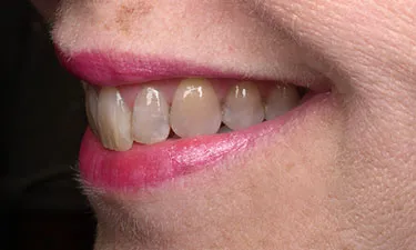 Anterior Crowns, pre-treatment