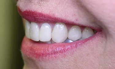 Anterior Crowns, post-treatment