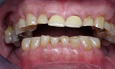 Full Mouth Reconstruction, pre-treatment