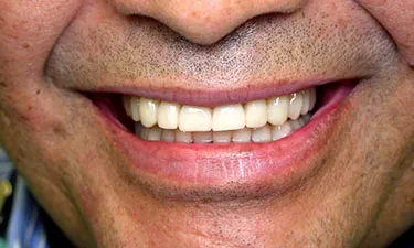 Full Mouth Reconstruction, post-treatment
