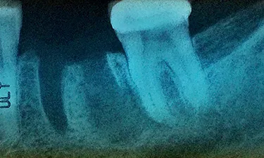 Dental Bone Graft, pre-treatment