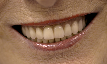 Fixed Upper & Lower Hybrids, post-treatment