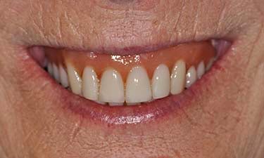 Fixed Upper & Lower Hybrids, pre-treatment