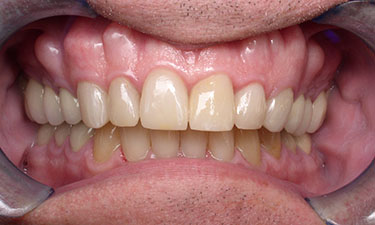 Crowns-In-A-Day, post-treatment