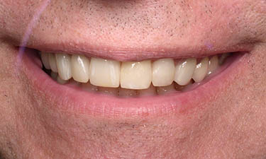 Dental Crowns-In-A-Day, post-treatment smile