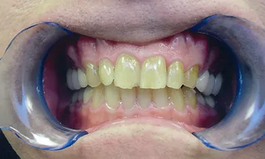 Crowns-In-A-Day, pre-treatment