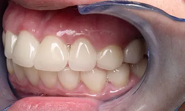 Full Mouth Rehabilitation, post-treatment from side