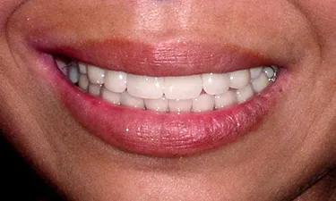 Full Mouth Rehabilitation, post-treatment smile