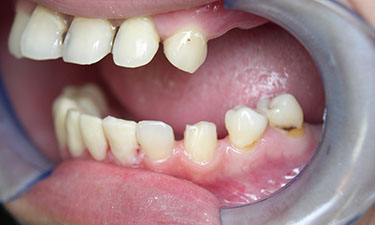Full Mouth Rehabilitation, pre-treatment from side