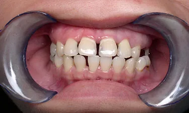 Full Mouth Rehabilitation, pre-treatment