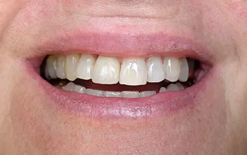 Single Tooth Replacement, post-treatment