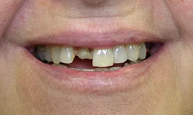 Single Tooth Replacement, pre-treatment