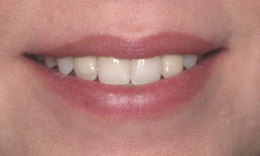 Crowns, post-treatment smile