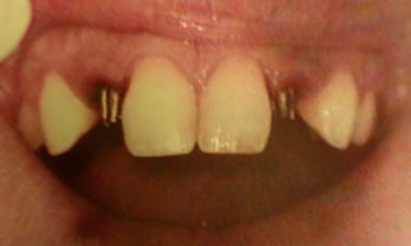 Implants for a lifetime