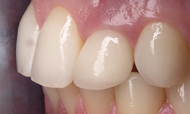 Crowns, post-treatment from left