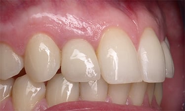 Crowns, post-treatment from right