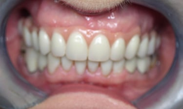 Maxillary Hybrid, post-treatment