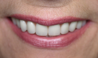 Maxillary Hybrid, post-treatment smile