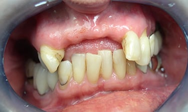 Maxillary Hybrid, pre-treatment without dentures