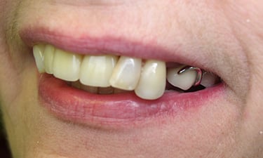 Maxillary Hybrid, pre-treatment smile with dentures